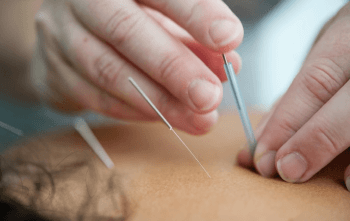 acupuncture img
