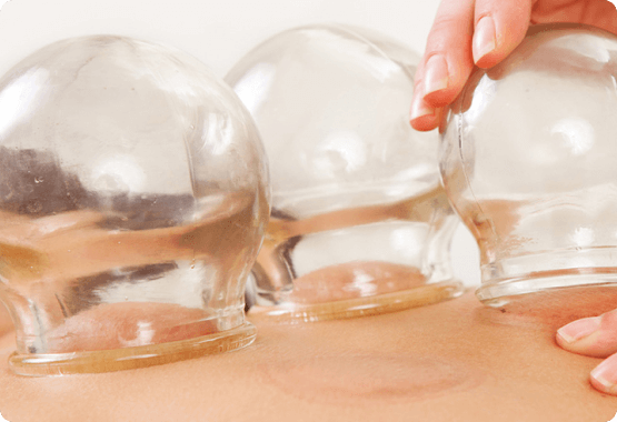 cupping 1