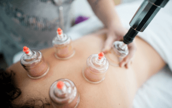cupping img