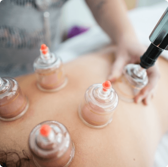 cupping