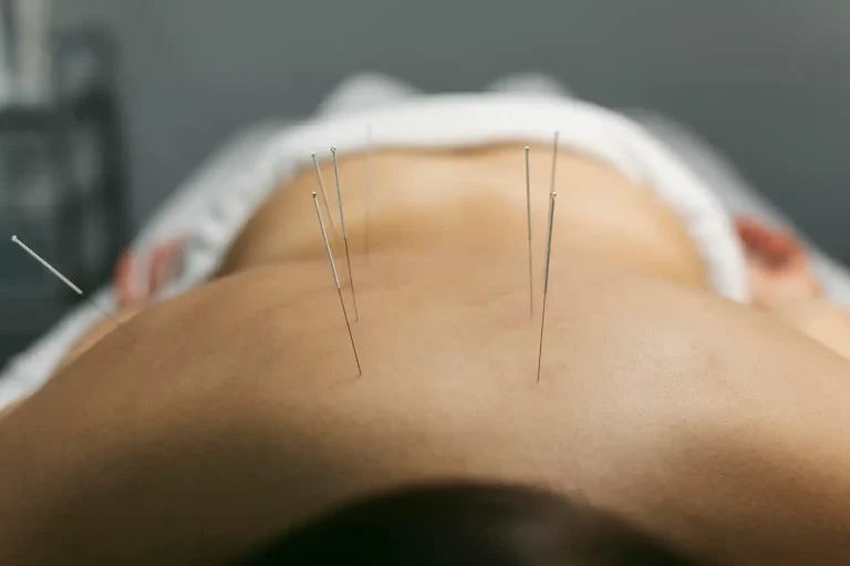 Acupuncture for weight loss in Dubai