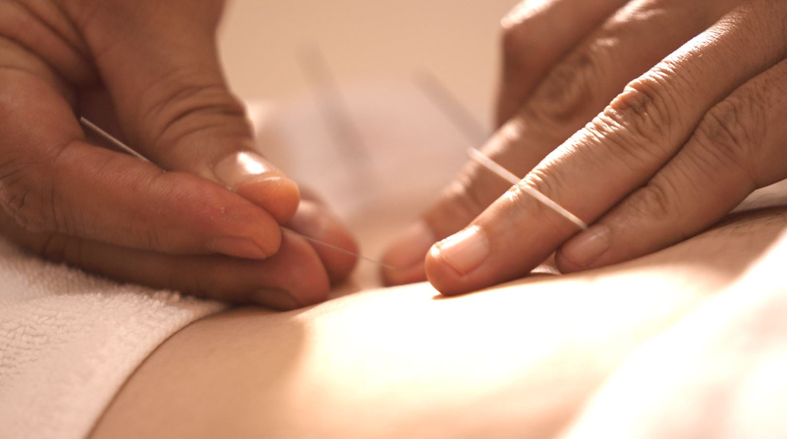 ACUPUNCTURE