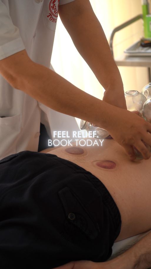 CUPPING 5