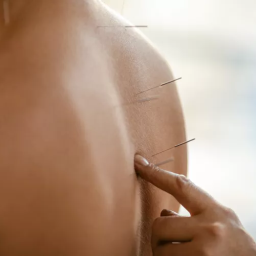 Introduction to Acupuncture