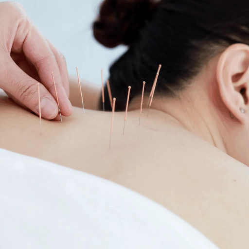 How Acupuncture Works for Back Pain