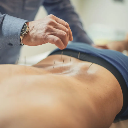 Acupuncture for Sciatica: Efficacy and Safety